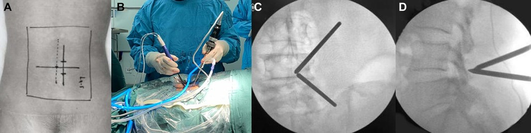disc-herniation-slipped-disc illustration 4