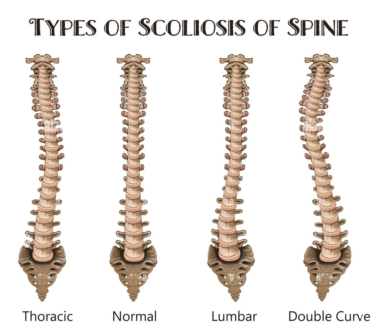 scoliosis illustration 2