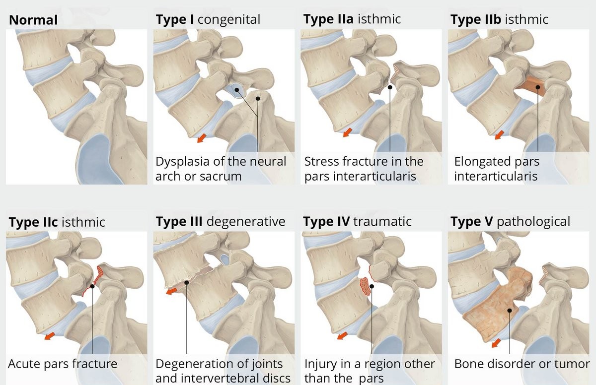 spondylolisthesis illustration 2
